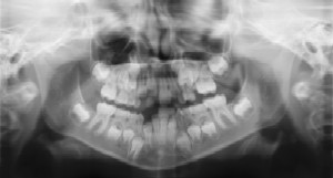 an x-ray of child's teeth