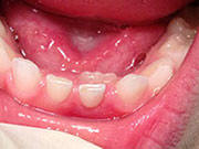 picture of a child's mouth with a permanent tooth growing in behind their baby teeth